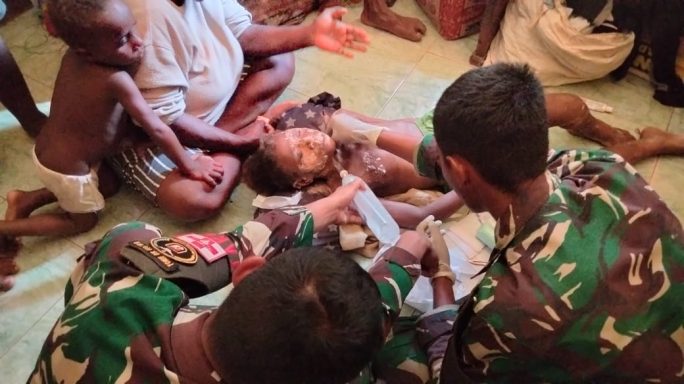 Dengan Cepat Tim Kesehatan Satgas Pamtas Statis RI-PNG Yonif 111/KB Tangani Korban Luka Bakar